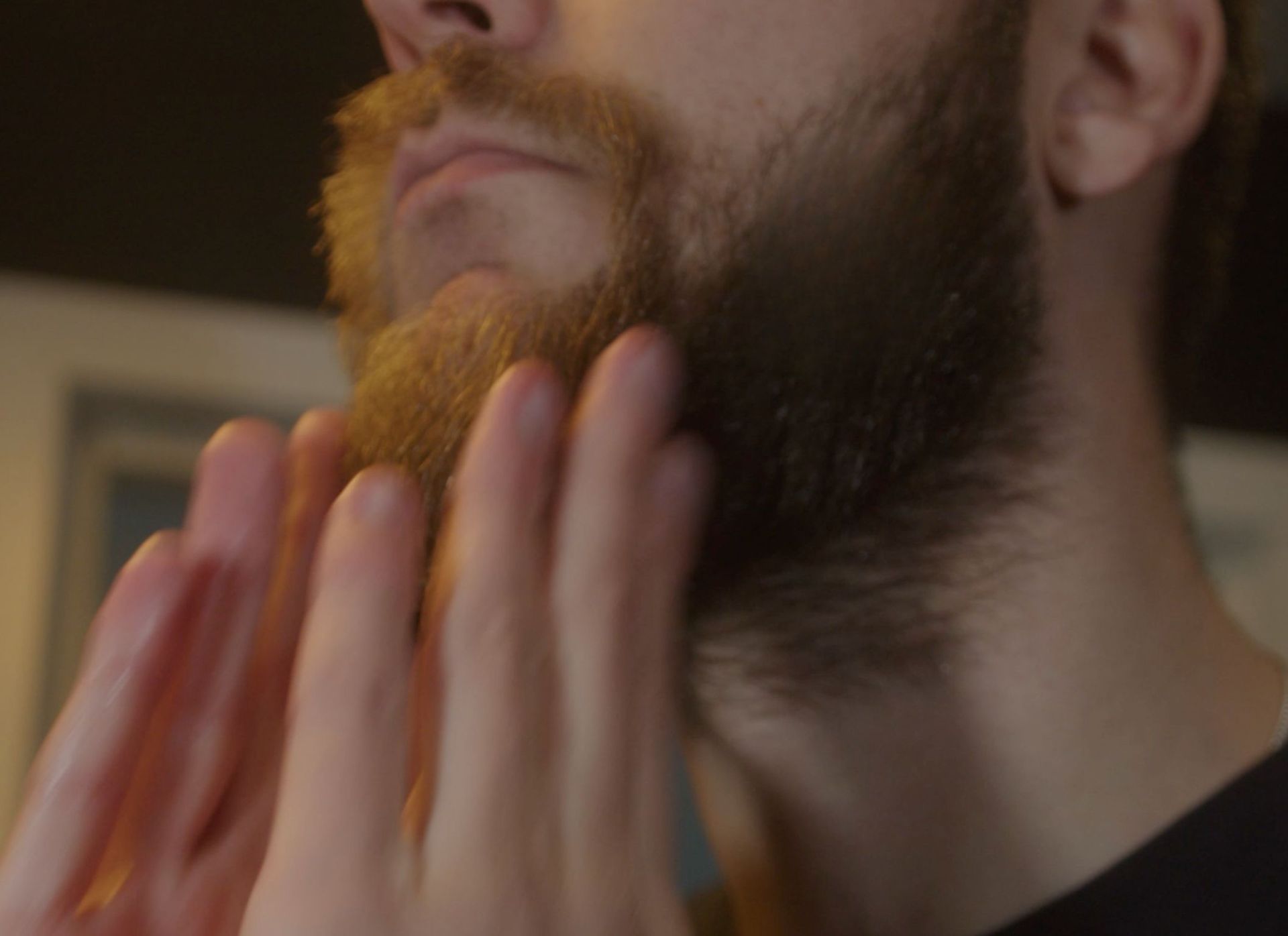 Alopecia Your Beard's Worst Nightmare Odenson